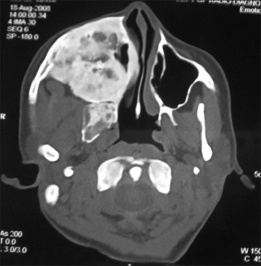 Axial CT image shows a radioopaque lesion occupyng most of the facial area in the mid and upper facial skeleton on the right side, which is significantly expanded. The maxillary sinus and nasal airway on the right are obliterated.