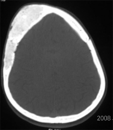 Axial CT image shows expansion of the right frontal and temporal bones.
