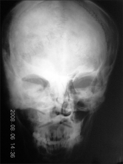 PA view of skull shows diffuse radiopacity with faint, linear to irregular central opacities.