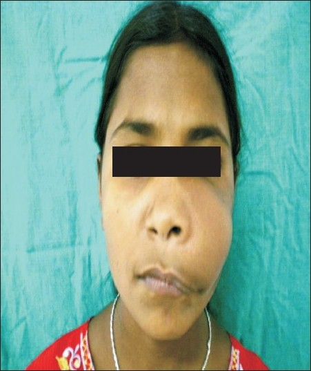 14-year-old girl with swelling on the left-side of the face at the time of evaluation.