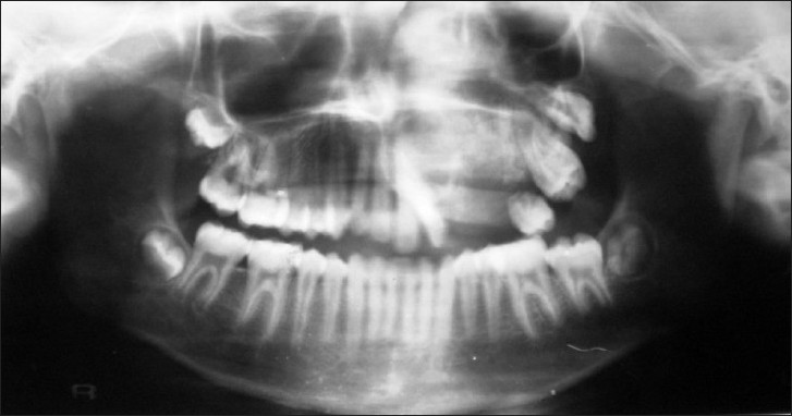 Panoramic radiograph of the patient shows radiopacity and displacement of teeth.