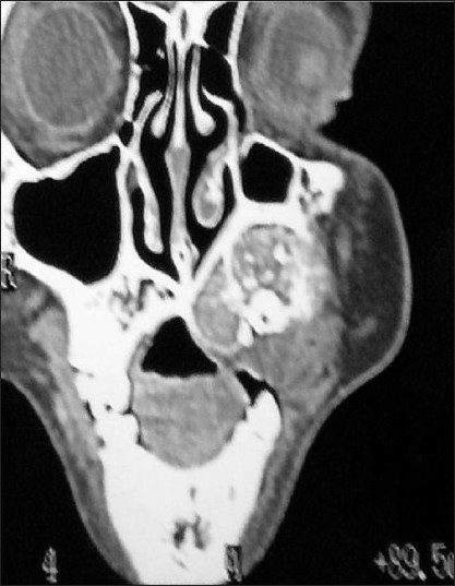Coronal CT shows obliteration of left maxillary sinus and displacement of teeth.