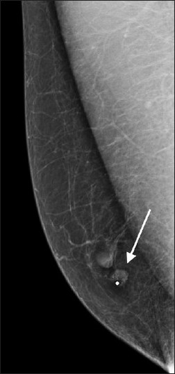 Mediolateral oblique view of mammogram demonstrates a small well-circumscribed oval mass just underneath a radiopaque skin marker in the medial right breast near the nipple. The mass contains multiple small punctuate calcifications.