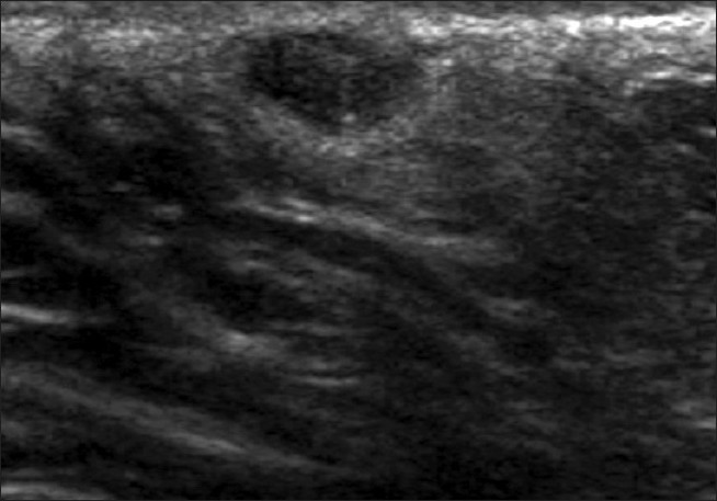 A well-circumscribed breast lesion on gray-scale ultrasound parallel to the skin surface has not been biopsied but is likely to be benign given its stability on sonography for nearly two years.