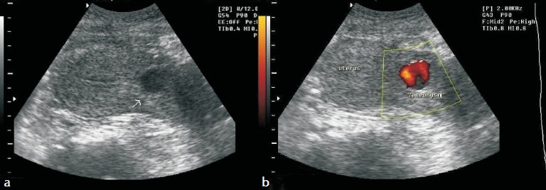 (a) Gray-scale ultrasound of the pelvis shows a hypoechoic lesion in the anterior wall of uterus. (b) Power Doppler evaluation of the uterus demonstrates blood flow within this hypoechoic lesion.