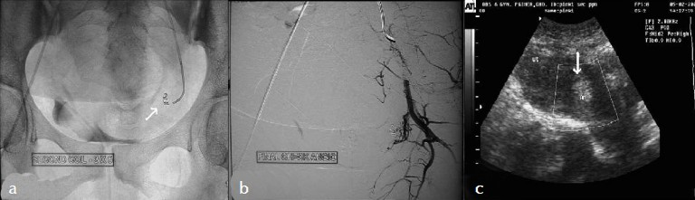 (a) Embolization coils (arrow) within the pseudoaneurysm. (b) Selective left internal iliac angiogram (Postembolization) using gelfoam and embolization coils show complete obliteration of the pseudoaneurysm. (c) Follow up color Doppler sonography shows no evidence of blood flow within the pseudoaneurysm.