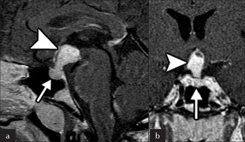 (a) Sagittal and (b) coronal images of pituitary and hypothalamus Involvement. There is extensive enhancement of the pituitary gland (arrow) and stalk (arrowhead), which is markedly enlarged.