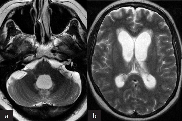 Hydrocephalus. Axial T2-weighted sequences at the level of the (a) fourth ventricle and (b) lateral ventricles show dilatation of these structures.