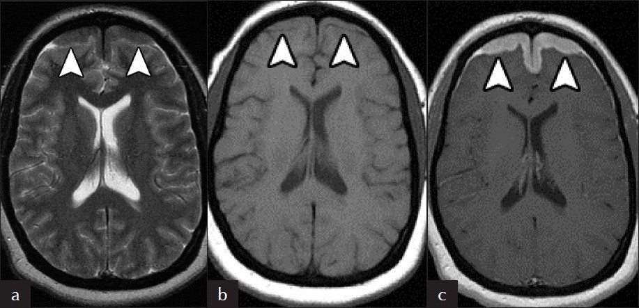 Dural Involvement. There is (a) hypointense T2 and (b) isointense T1signal in the (c) symmetrically thickened frontal lobe dura, which avidly enhance on post-contrast T1 MRI (arrowheads).