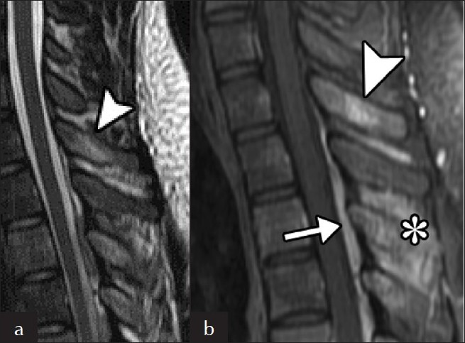 Vertebral involvement. (a) Sagittal T2 and (b) post-contrast T1 sequences show a hyperintense, enhancing focus on the posterior elements of the thoracic spine (arrowhead). There is also enhancement of the interpinous ligaments (*) and posterior extradural enhancement (arrow).