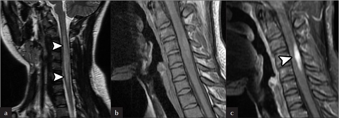 Intramedullary spinal cord involvement. (a) Sagittal T2, (b) sagittal T1 and (c) sagittal post-contrast T1 sequences is high T2 signal within the spinal cord (arrowheads). A portion of the lesion demonstrates intense enhancement (arrowhead). The cord is mildly expanded.