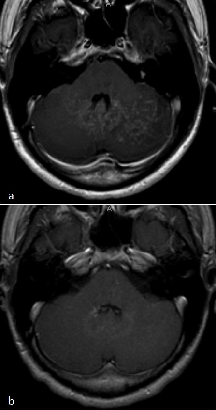 Treatment response. Axial post-contrast T1 sequences (a) before and (b) after initiation of steroids shows near resolution of the serpiginous cerebellar hemisphere lesions within eight months.