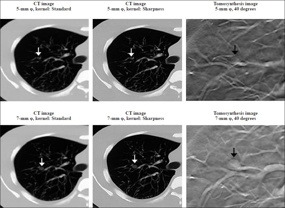 Tomosynthesis (SonialVision Safire II, Shimadzu Co., Kyoto, Japan) and CT (64-slice SOMATOM Definition scanner; Siemens Medical Systems, Forchheim, Germany) images of the artificial pulmonary nodules (ground-glass opacity type). The quality of the images obtained by tomosynthesis imaging were clearer than those obtained by CT (CT slice thickness: 5 mm).