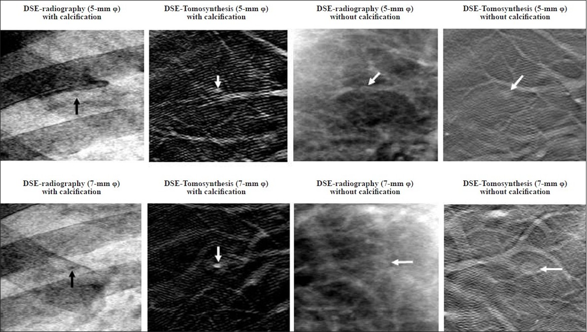 DES-Tomosynthesis and DES radiography (SonialVision Safire II) of the same slice, demonstrates the content of the artificial pulmonary nodules with and without calcification. The high-contrast detectability phantom case having a clear, contrast detectability on DES-Tomosynthesis imaging produced for identical planes (tomosynthesis acquisition angle: 40).