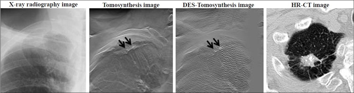 Calcified tuberculous foci in a 74-year-old man. Comparison of the chest images obtained with X-ray radiography, digital tomosynthesis, DES-Tomosynthesis, and high-resolution CT (HR-CT). DES-Tomosynthesis and HR-CT appear to have similar accuracy in detecting calcification in the pulmonary nodules. However, DES-Tomosynthesis has a greater clinical potential.