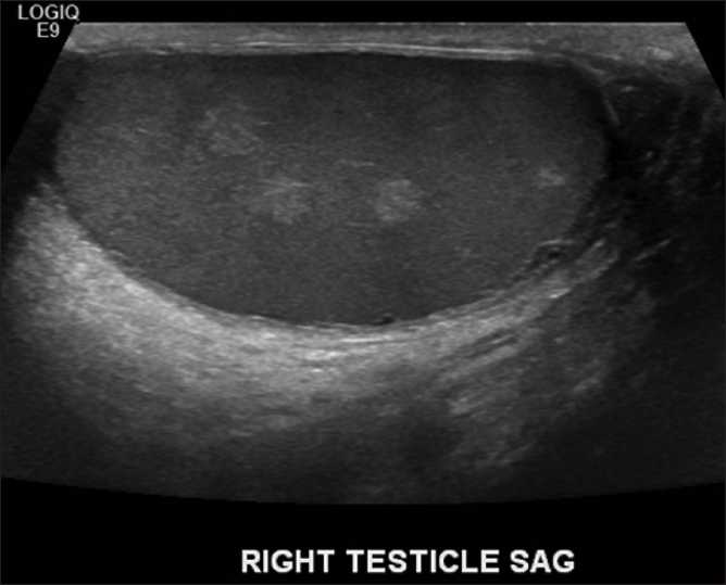 Gray-scale ultrasound of the right testis. Multiple ill-defined hyperechoic lesions within the parenchyma, representing likely contusions. They resolved on follow-up examination.