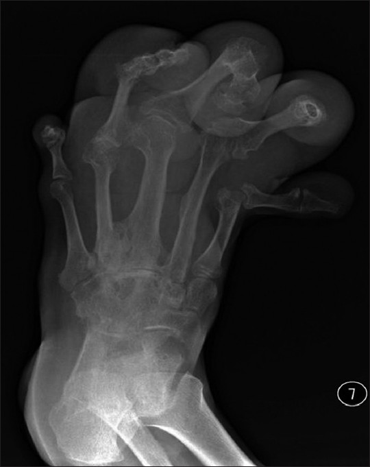 Plain radiograph shows soft tissue swelling involving second, third, and fourth toes with hypertrophy of phalanges and plantar angulation of the distal end of the affected toes.
