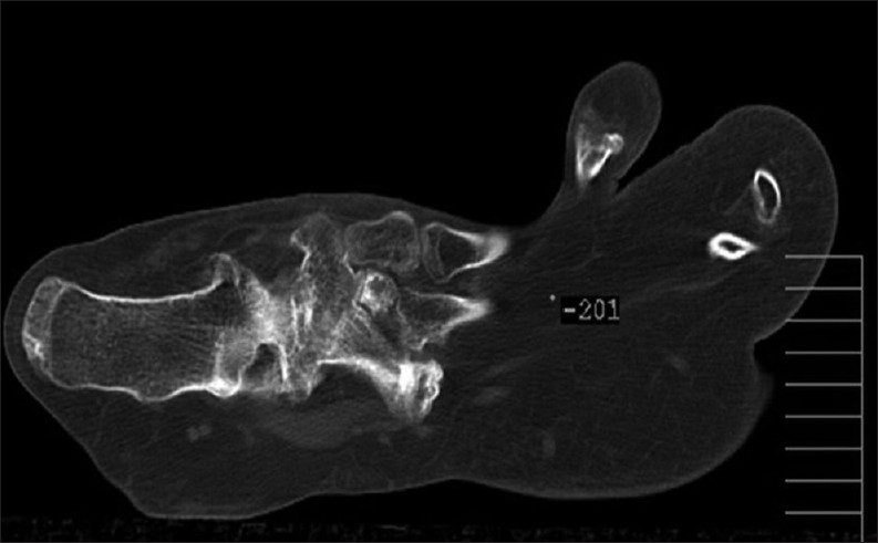 Computed tomography shows abundant soft tissue with fat density, and fanning of phalanges.