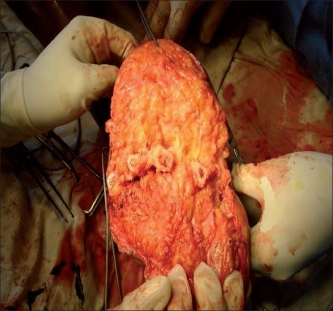 Intraoperative photograph shows abundant adipose tissue and trans-metatarsal amputation.