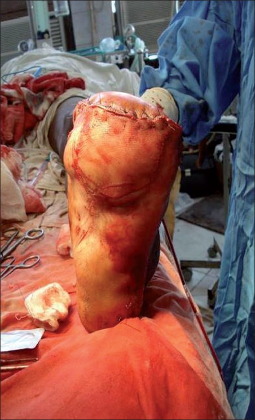 Postoperative photograph taken after myoplasty.