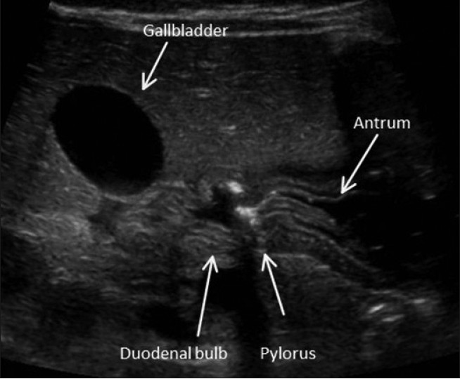 Sonographic image of a healthy infant shows the gastroduodenal junction in a transverse plane.