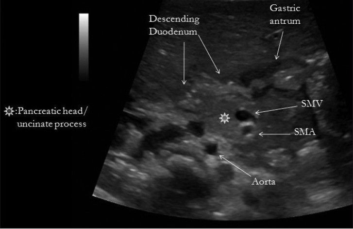 Sonographic image of a healthy infant shows the retroperitoneum in a transverse plane.