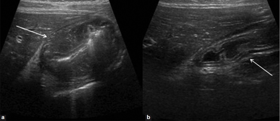 Gastritis. US in a transverse plane shows (a) marked mural thickening (arrow) and (b) Resolution following appropriate therapy (arrow).
