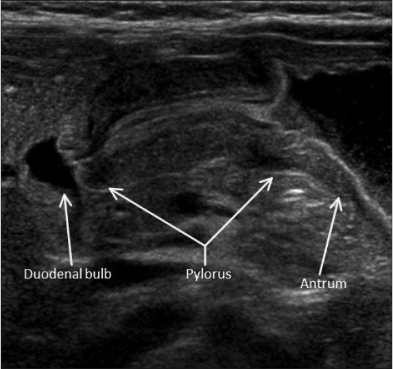 Hypertrophic pyloric stenosis. Sonographic image in a transverse plane