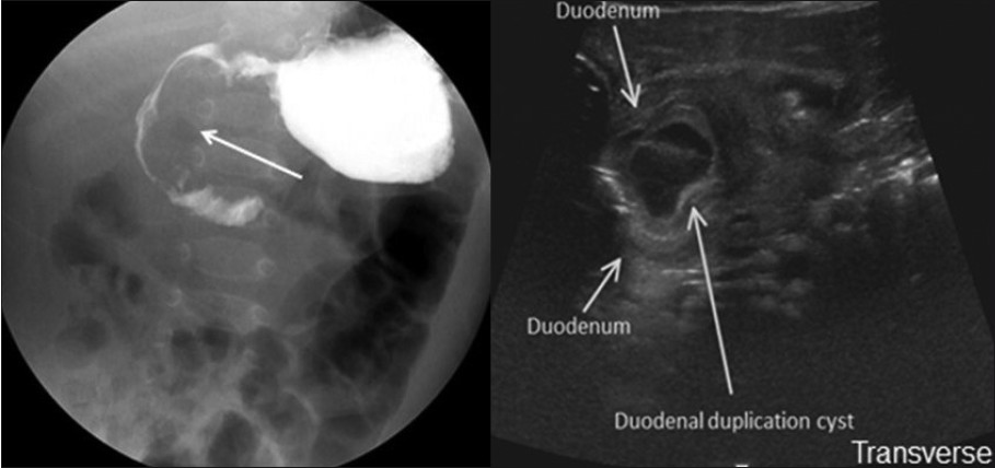 Duodenal duplication cyst. (a) Frontal fluoroscopic projection demonstrates effacement of the medial aspect of the descending portion of the duodenum (arrow). (b) Sonographic UGI in a transverse plane demonstrates descending portion of duodenum and duplication cyst.