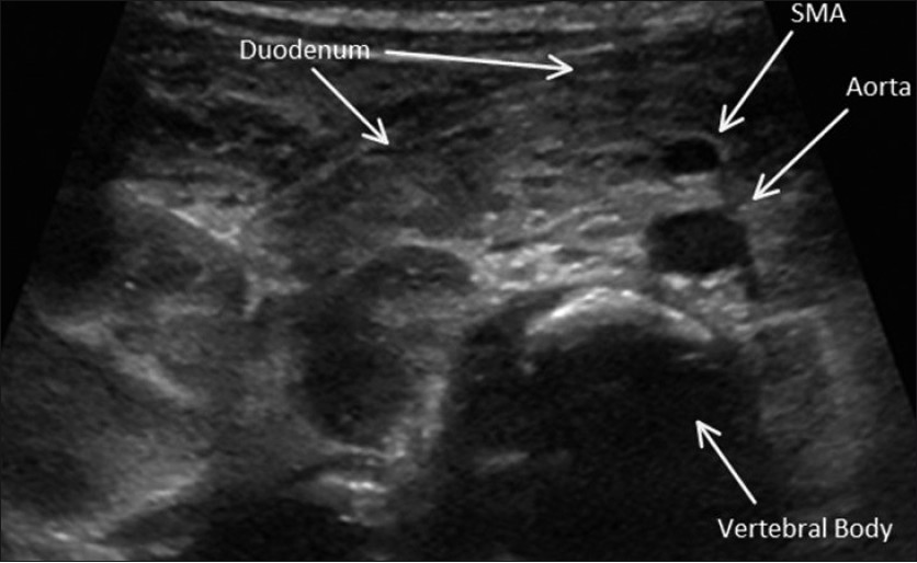 Malrotation. Sonographic image in a transverse plane shows the transverse portion of the duodenum courses anterior to the superior mesenteric artery (SMA). No small bowel is seen interposed between SMA and abdominal aorta.