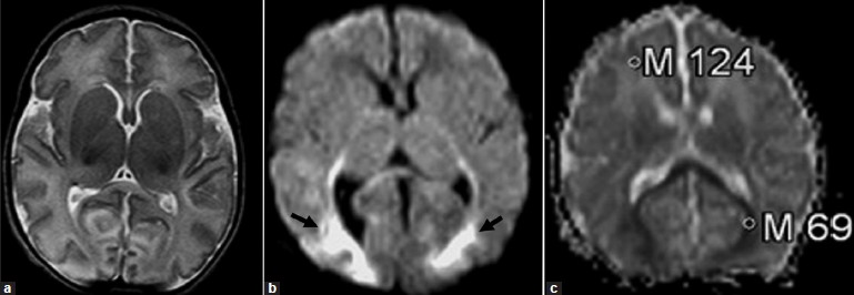 Neonatal adrenoleukodystrophy: (a) the axial T2-weighted MR image is normal; (b) the diffusion-weighted image (b = 1000 sec/mm2) reveals high-signal changes in the splenium of the corpus callosum, and occipital lobes (black arrows); (c) the ADC map reveals that the ADC values of the involved regions is low (0.69 × 10–3 mm2/sec), compared to the frontal regions (1.24 × 10–3 mm2/s).