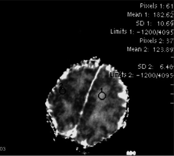 A healthy 4-day-old boy. ADC map: normal parechymal values. ADC measurements are shown by region of interest (ROI) evaluations. Large ROI evaluations from different regions in the parenchyma reveal normal ADC values: 1.82 and 1.23 × 10–3 mm2/sec.