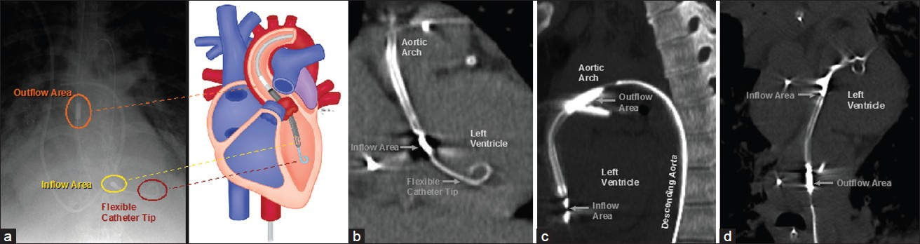 Impella 2.5 components on radiograph and CT. (a) Frontal radiograph and the corresponding diagram show components (labeled) of the percutaneous ventricular assist device with respect to anatomic structures. (b) Coronal MIP, (c) sagittal MIP, and (d) vessel trace CT images demonstrate the main parts (labeled) of the percutaneous ventricular assist device in normal positions.