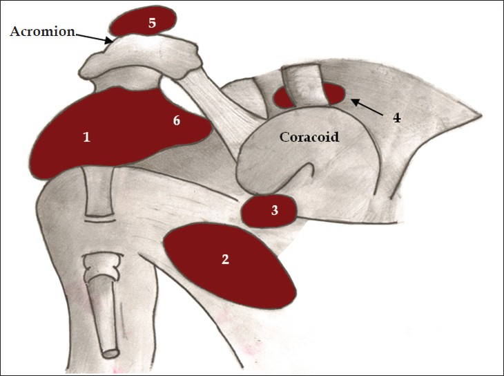 Diagram of normal bursae surrounding the shoulder joint: (1) subacromial-subdeltoid bursa, (2) subscapular recess, (3) subcoracoid bursa, (4) coracoclavicular bursa, (5) supra-acromial bursa and (6) medial extension of subacromial-subdeltoid bursa.