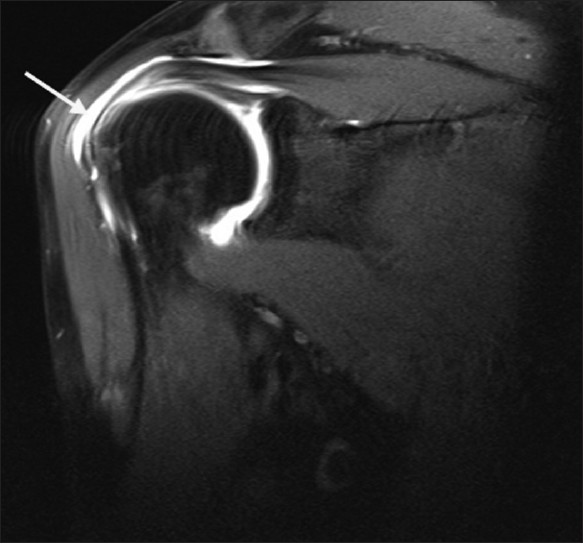 subdeltoid bursitis mri