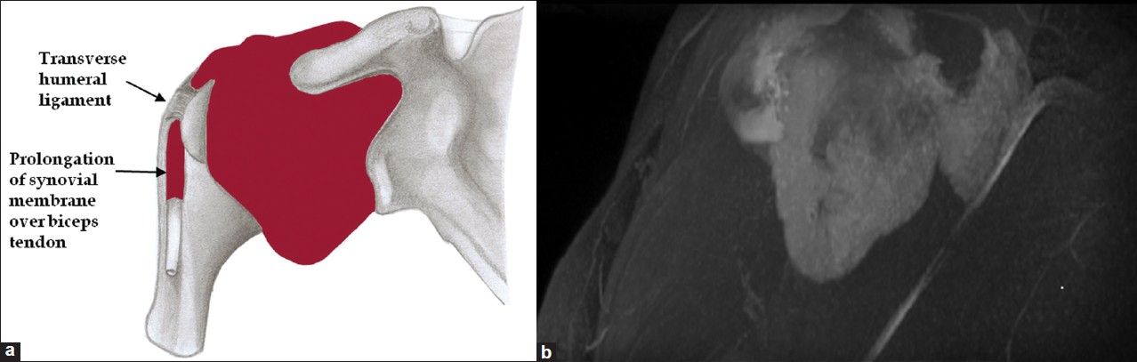 subdeltoid bursitis mri