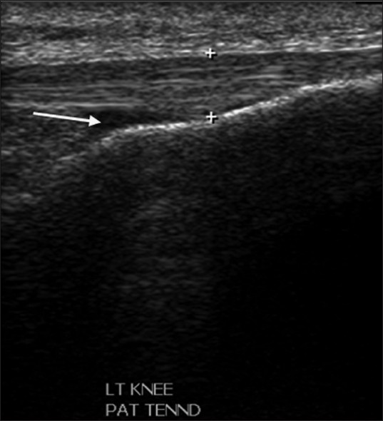 Ultrasound in the longitudinal plane showing deep infrapatellar bursal fluid.