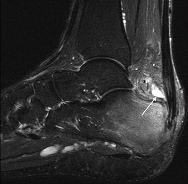 Sagittal magnetic resonance T2 fat sat image showing retrocalcaneal bursitis with a thick synovial wall.