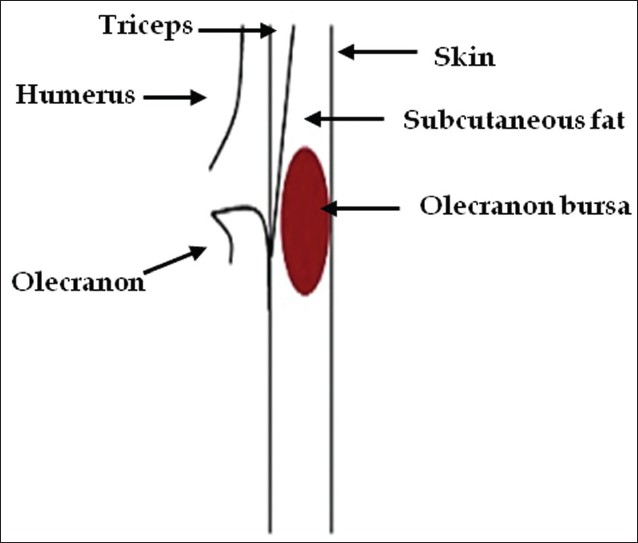 Line diagram depicting location of the olecranon bursa.