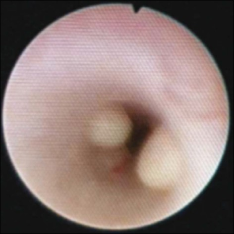 A 62-year-old female with ureteritis cystica of bilateral ureters. Retrograde pyleogram shows multiple smooth, well-rounded filling defects with sharp borders that protrude into the lumen of the ureter.
