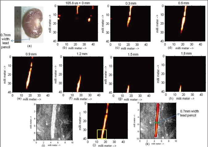 Photoacoustic imaging of the lead pencil embedded within the lamb kidney. (a) A photograph of the lamb kidney with a lead pencil (arrow) embedded within it. (b) – (h) The 0.3 mm thick c-scan slice traversing from the anterior to posterior plane of the lamb kidney. (i) Sonogram of the lamb kidney with embedded lead pencil acquired with a 40 MHz probe. (j) PA image of lead pencil embedded within the lamb kidney by adding (b)-(h). (k) Fused ultrasound and PA image by combining (i) with a portion of PA image in (j) shown in a square box.