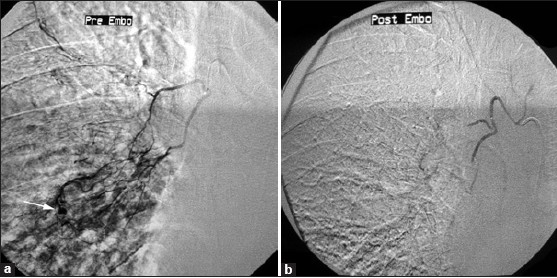 Superselective embolization with a microcatheter. (a) Selective arteriogram of the right bronchial artery shows hypervascularity in right middle zone with enlarged arteries and a small aneurysm (arrow). (b) After embolization with PVA particles, the hypervascular area and the aneurysm are not visualized.