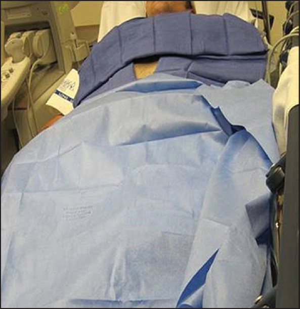 The skin site is prepped and draped in a sterile fashion.
