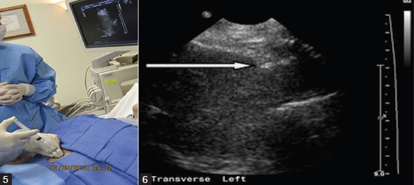 Under ultrasound guidance, the deep soft tissues and liver pericapsular areas are also infiltrated with local anesthetic.