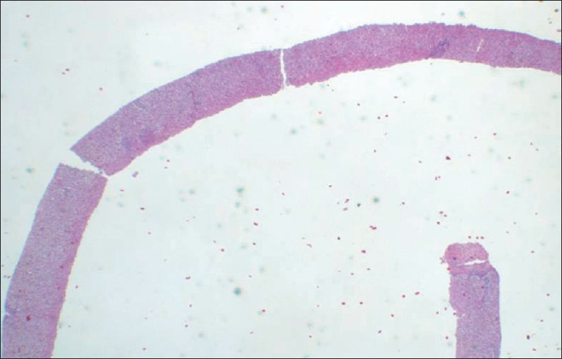 The size of the specimen is very important for diagnosis and some pathologists recommend that the specimen contain from 6 to 11 complete portal triads for specimen adequacy. This is an adequate size and appearance of a desirable specimen.