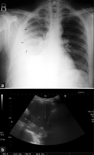 A 52-year-old male with rheumatoid arthritis (RA): (a) PA chest radiograph shows a moderate right sided pleural effusion (arrow), (b) correlative imaging with ultrasound shows distances from skin to effusion.