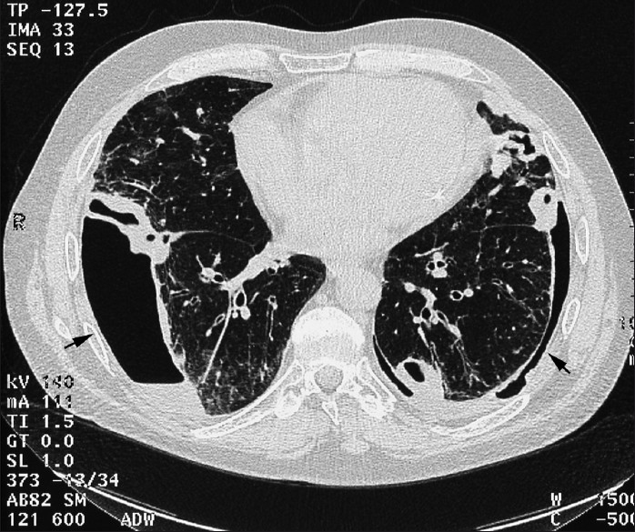 CT axial section from HRCT in a 68-year-old male RA patient shows subpleural basal nodules with pneumothoraces and effusions bilaterally.