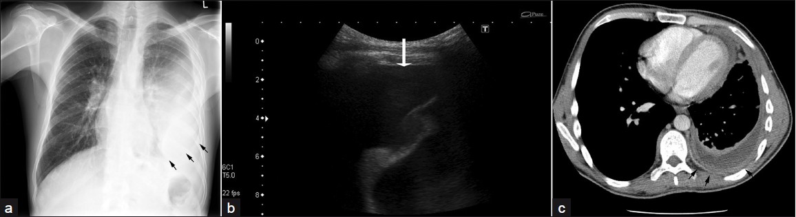 A 40-year-old male with RA: (a) PA chest radiograph shows a moderate left-sided pleural effusion (arrows), (b) US of same, (c) CT with high attenuation shows empyema, pleural thickening, and enhancement (arrows).