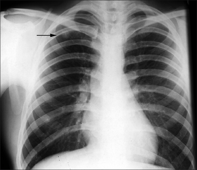 A 57-year-old male with RA shows a PA chest radiograph with a well-defined solitary nodule within the right upper zone.