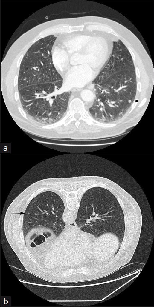 A 65-year-old male with RA: (a) arterial phase CT thorax axial section shows reticular subpleural opacification and necrobiotic nodules (arrow), (b) prone HRCT axial section taken three months later shows some resolution of the nodule (arrow) demonstrating their usual benign course.